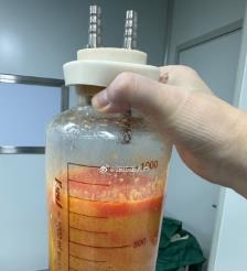 安康水动力吸脂手术要做多久？